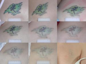Tatoeage tattoo verwijderen